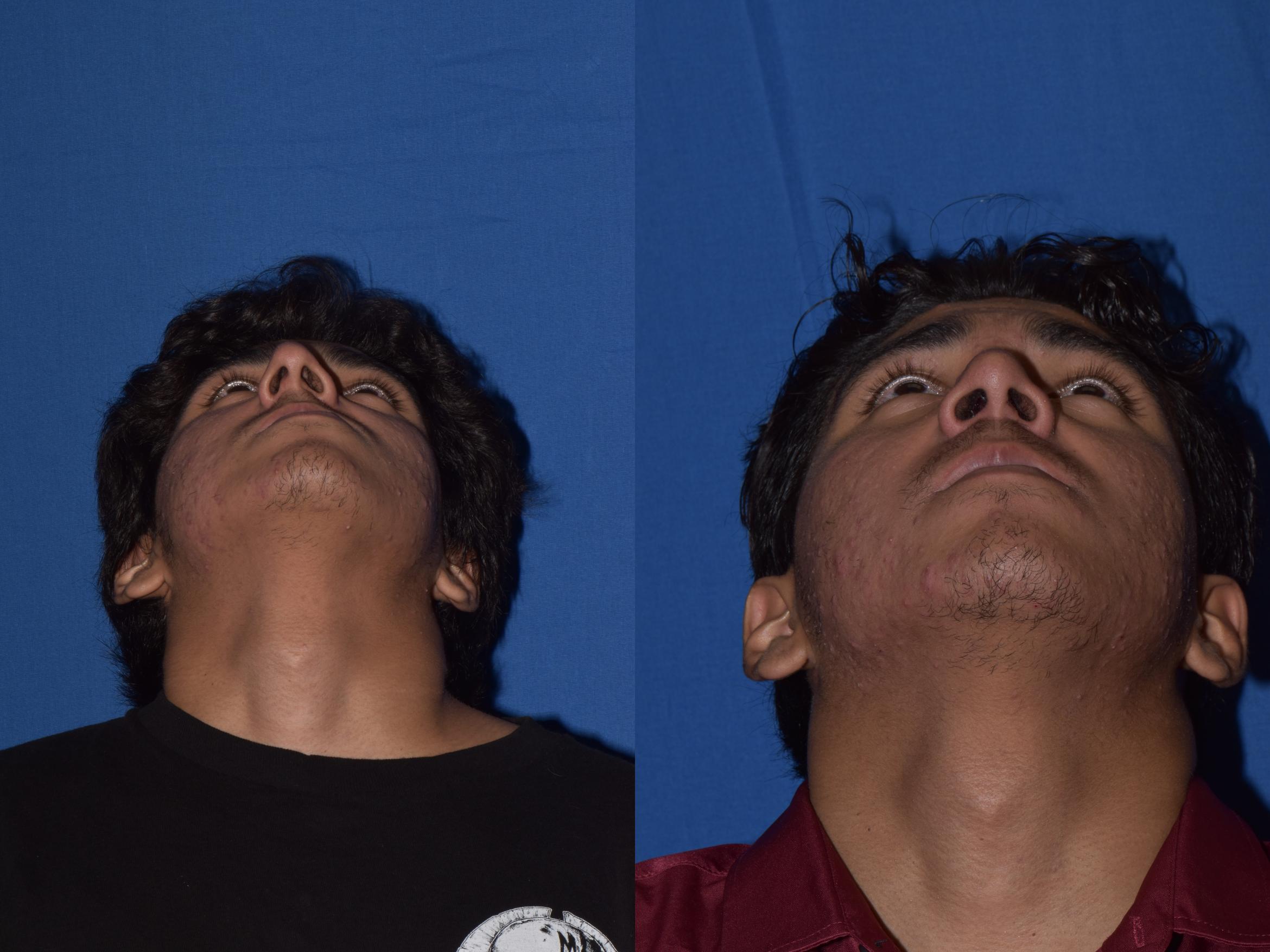 Before & After Rhinoplasty Case 15 Bottom View in South Miami, Florida