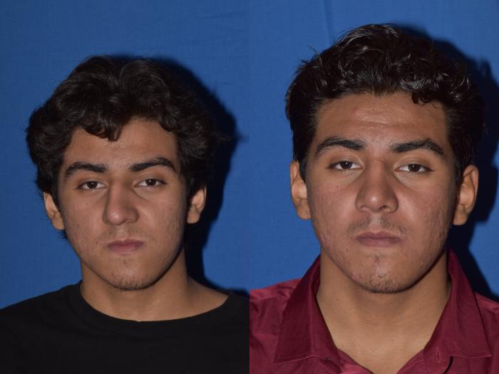 Before & After Rhinoplasty Case 15 Front View in South Miami, Florida