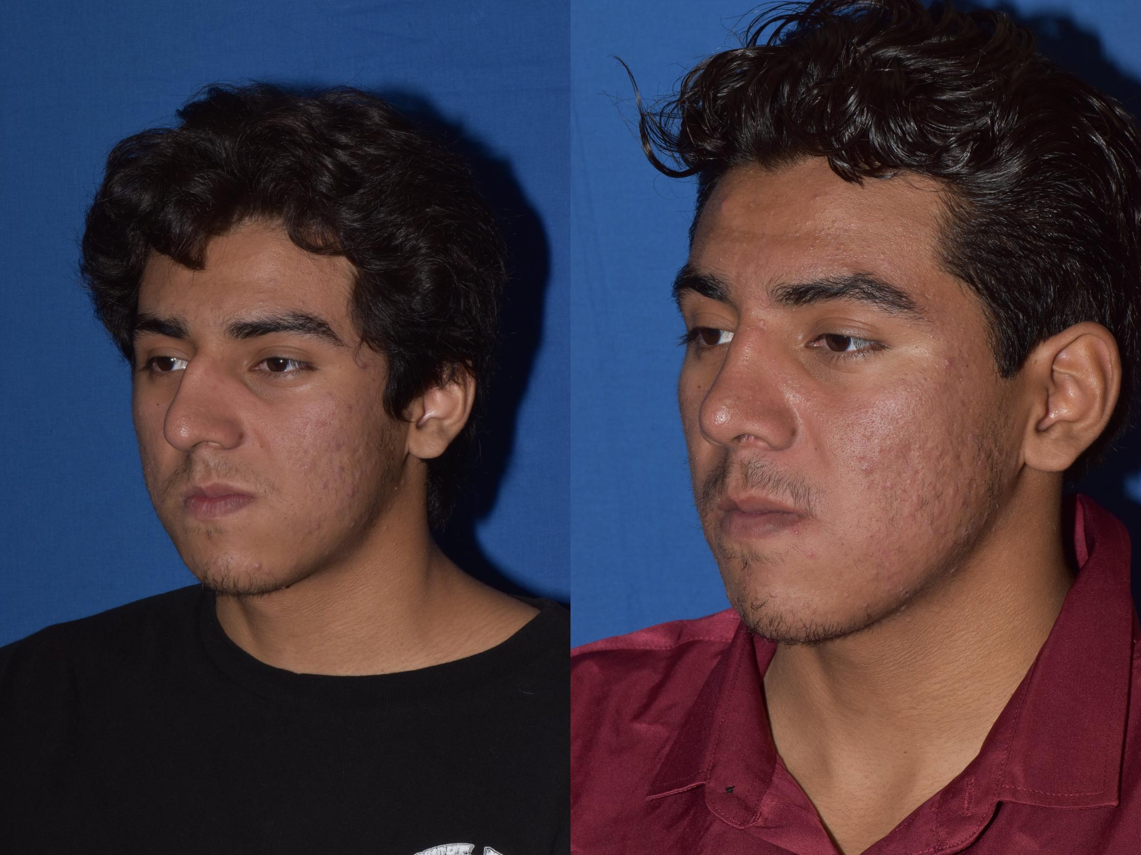 Before & After Rhinoplasty Case 15 Left Oblique View in South Miami, Florida