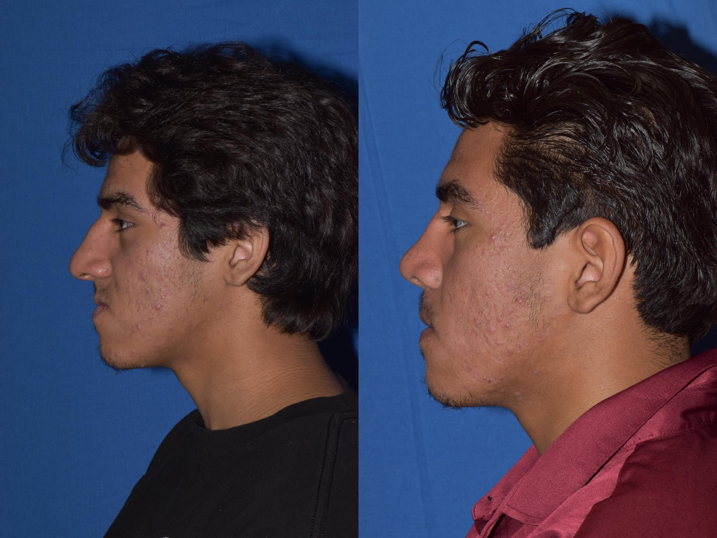 Before & After Rhinoplasty Case 15 Left Side View in South Miami, Florida