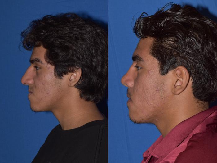 Before & After Rhinoplasty Case 15 Left Side View in South Miami, Florida