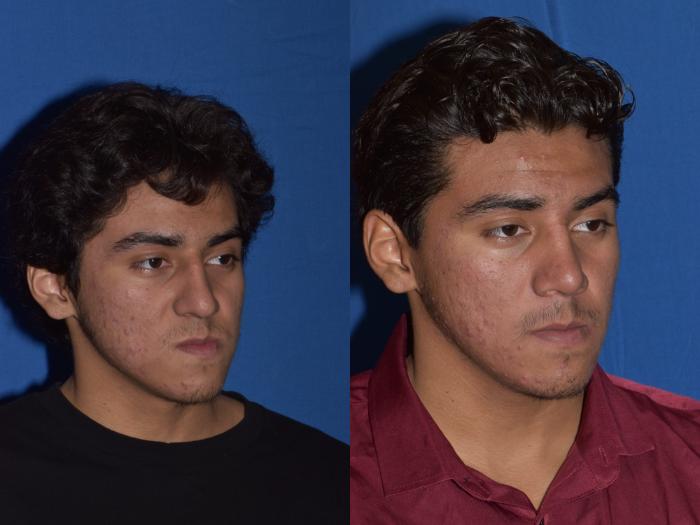 Before & After Rhinoplasty Case 15 Right Oblique View in South Miami, Florida