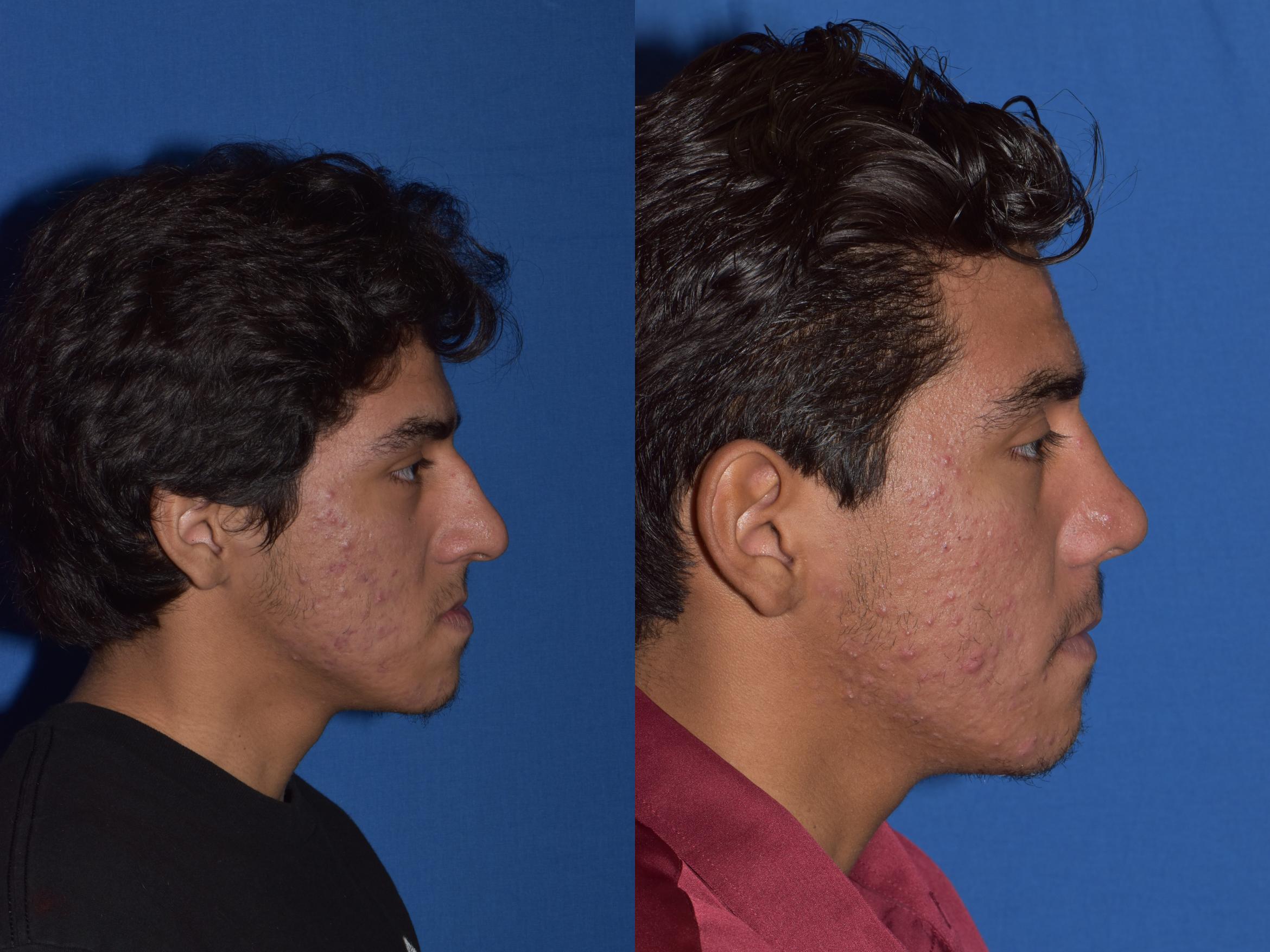 Before & After Rhinoplasty Case 15 Right Side View in South Miami, Florida