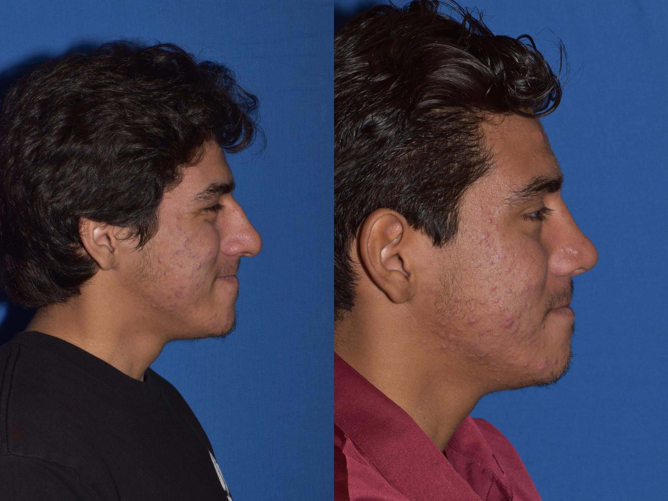 Before & After Rhinoplasty Case 15 Right Side Smiling View in South Miami, Florida
