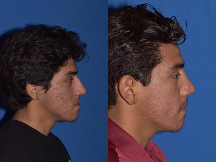 Before & After Rhinoplasty Case 15 Right Side View in South Miami, Florida