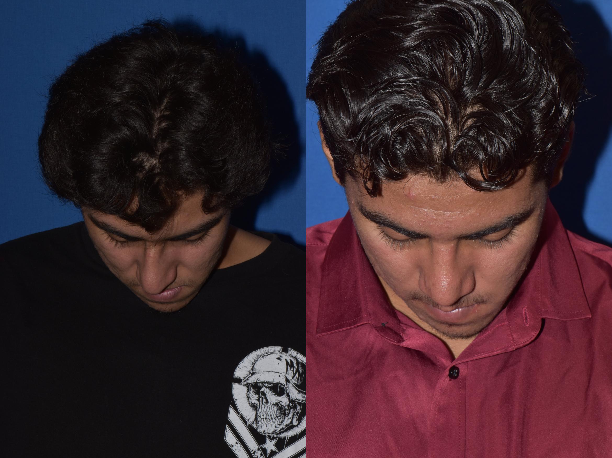 Before & After Rhinoplasty Case 15 Top View in South Miami, Florida