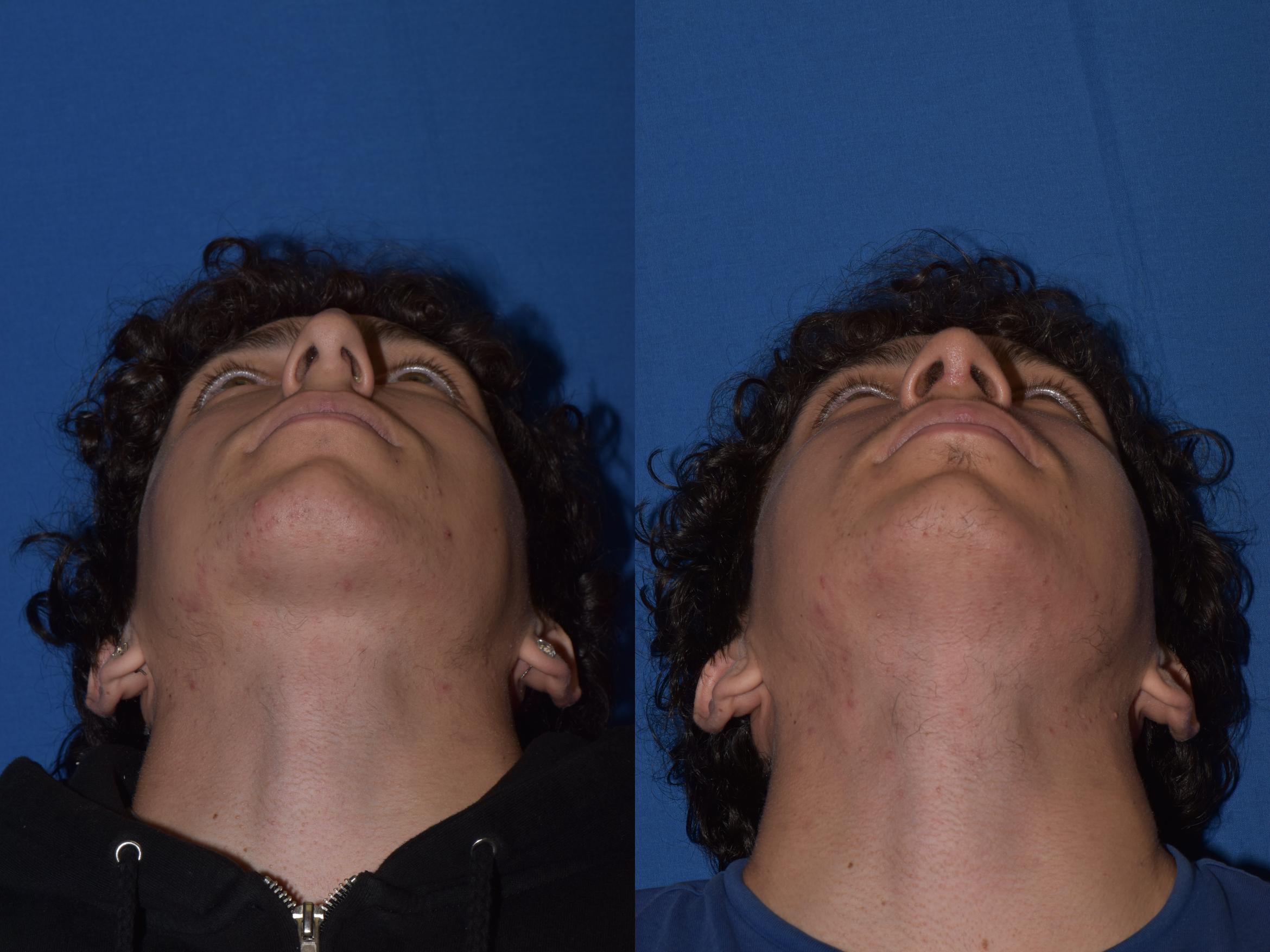 Before & After Rhinoplasty Case 16 Bottom View in South Miami, Florida