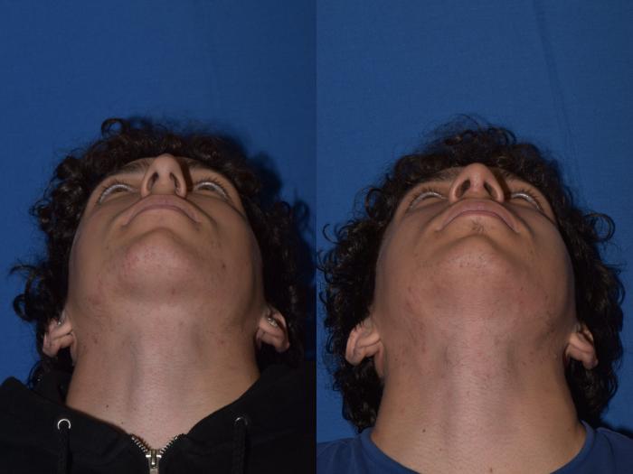 Before & After Rhinoplasty Case 16 Bottom View in South Miami, Florida