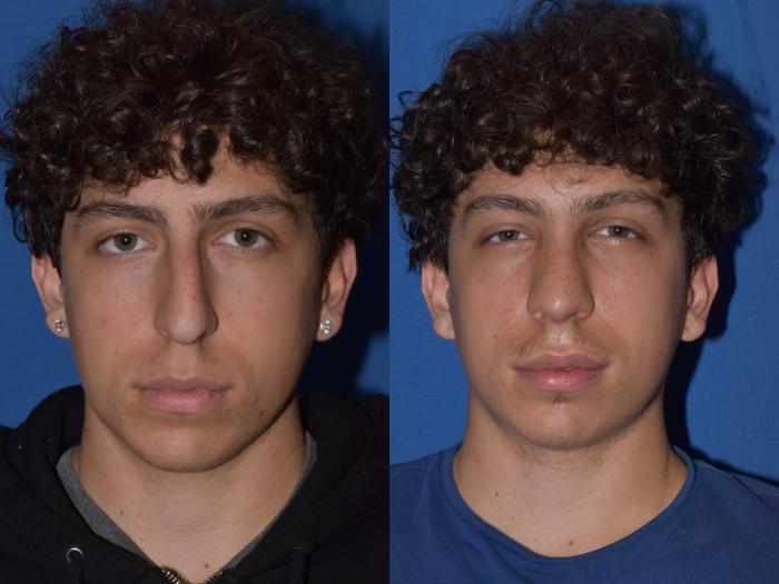 Before & After Rhinoplasty Case 16 Front View in South Miami, Florida