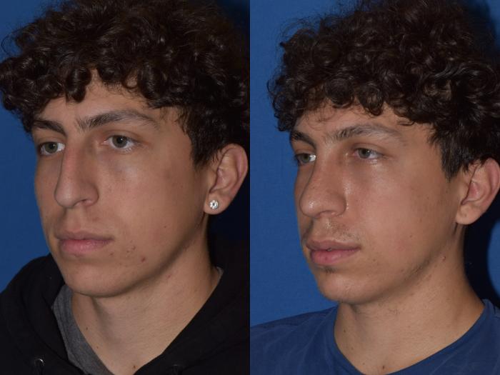Before & After Rhinoplasty Case 16 Left Oblique View in South Miami, Florida