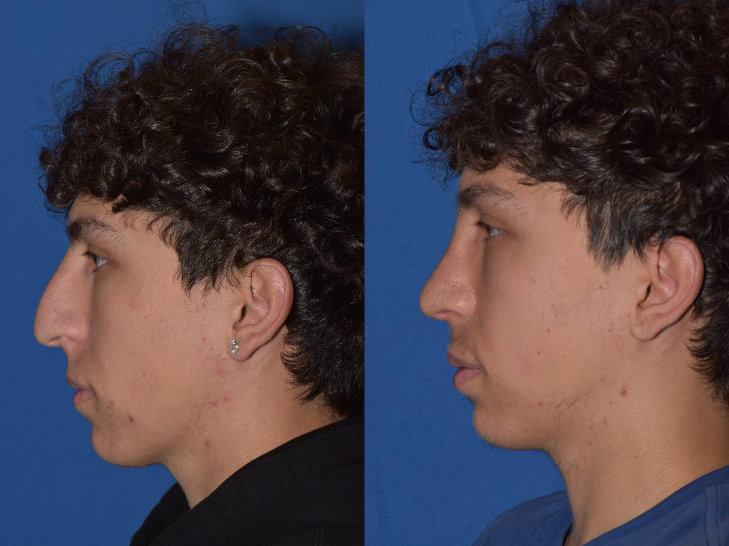 Before & After Rhinoplasty Case 16 Left Side View in South Miami, Florida