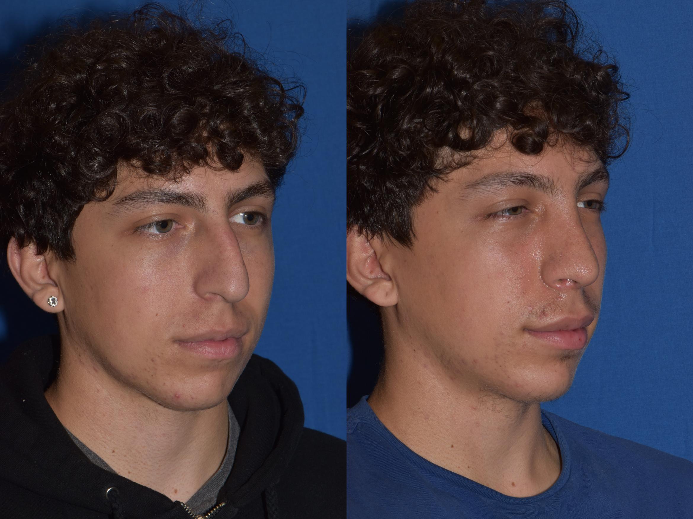 Before & After Rhinoplasty Case 16 Right Oblique View in South Miami, Florida