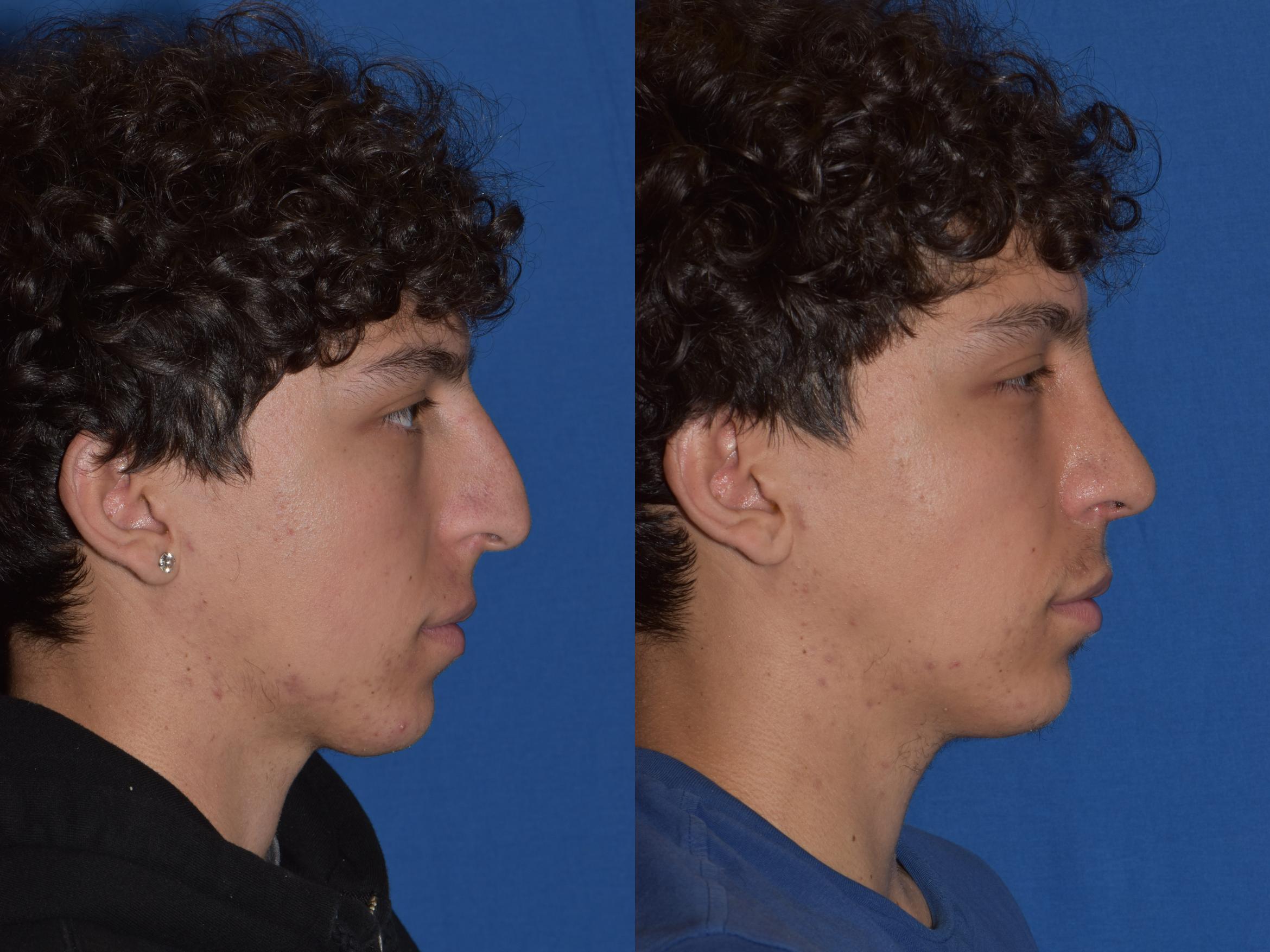 Before & After Rhinoplasty Case 16 Right Side View in South Miami, Florida