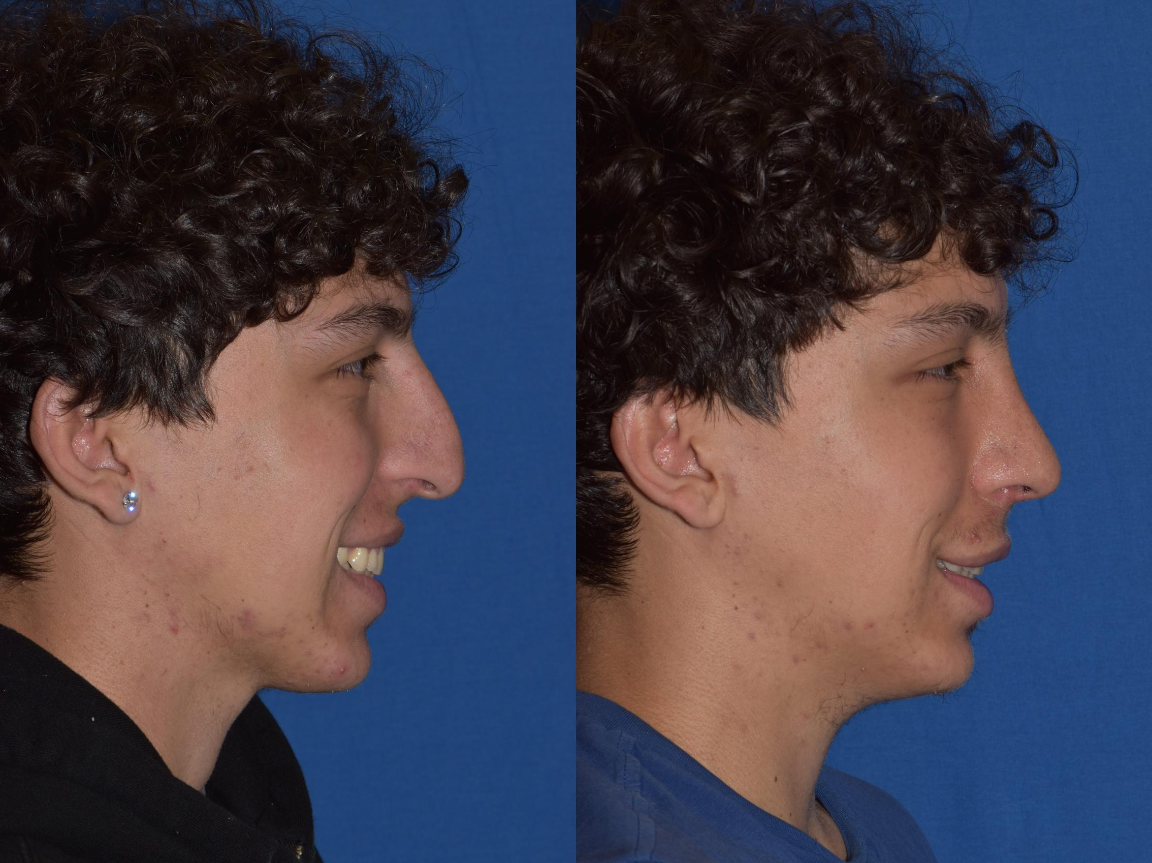 Before & After Rhinoplasty Case 16 Right Side Smiling View in South Miami, Florida