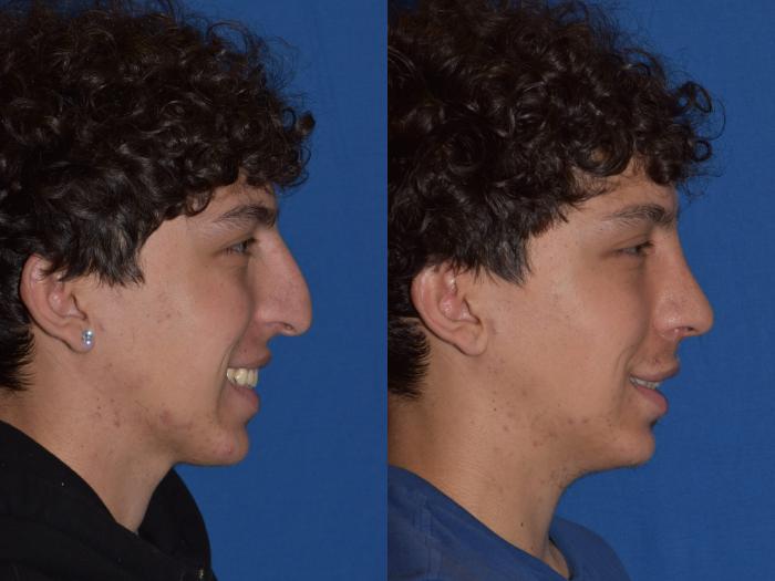 Before & After Rhinoplasty Case 16 Right Side Smiling View in South Miami, Florida