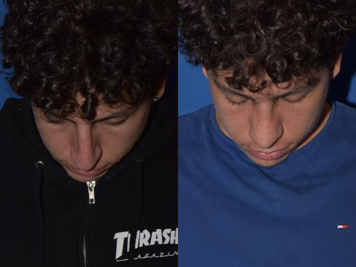 Before & After Rhinoplasty Case 16 Top View in South Miami, Florida