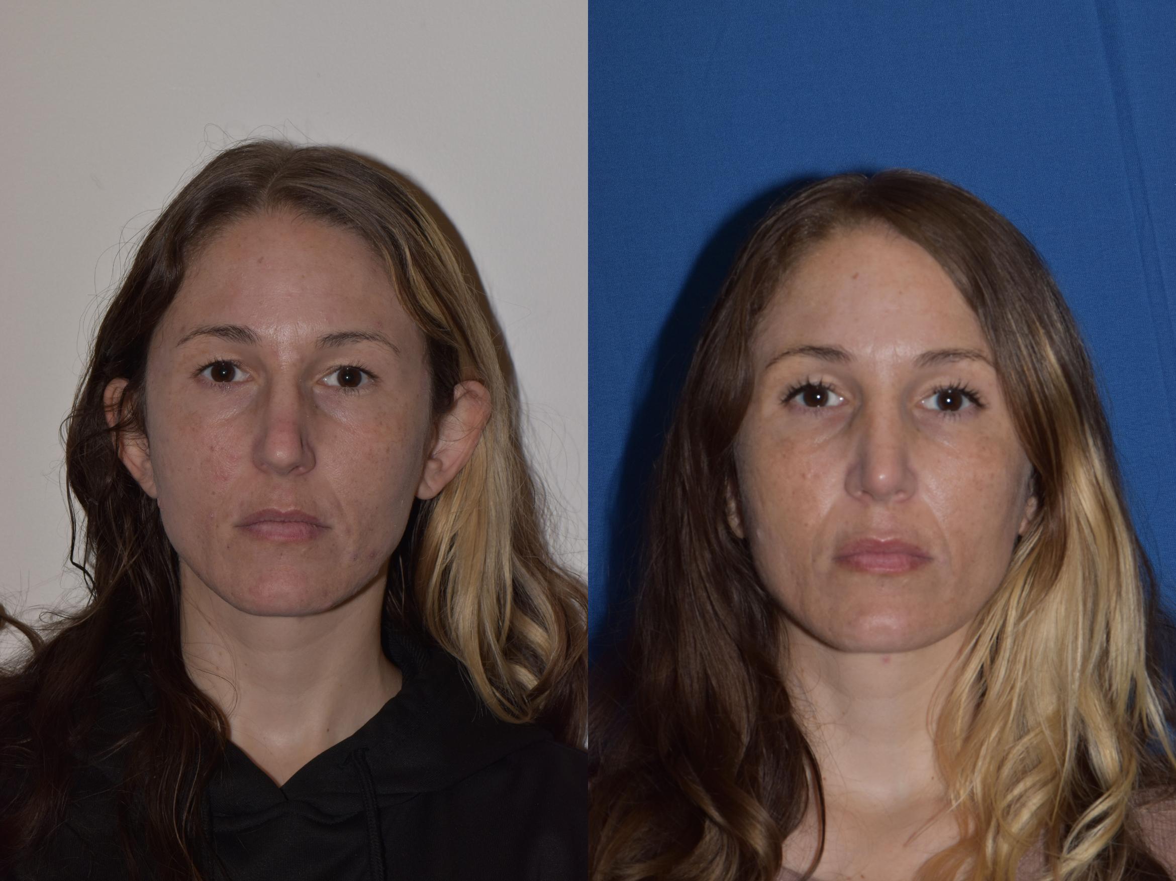Before & After Rhinoplasty Case 2 Front View in South Miami, Florida