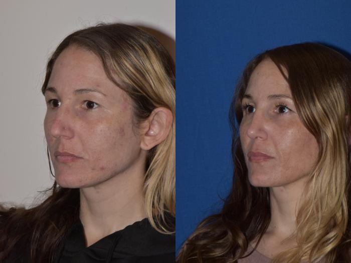Before & After Rhinoplasty Case 2 Left Oblique View in South Miami, Florida