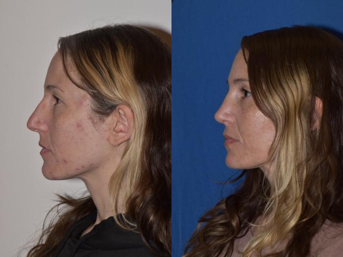 Before & After Rhinoplasty Case 2 Left Side View in South Miami, Florida