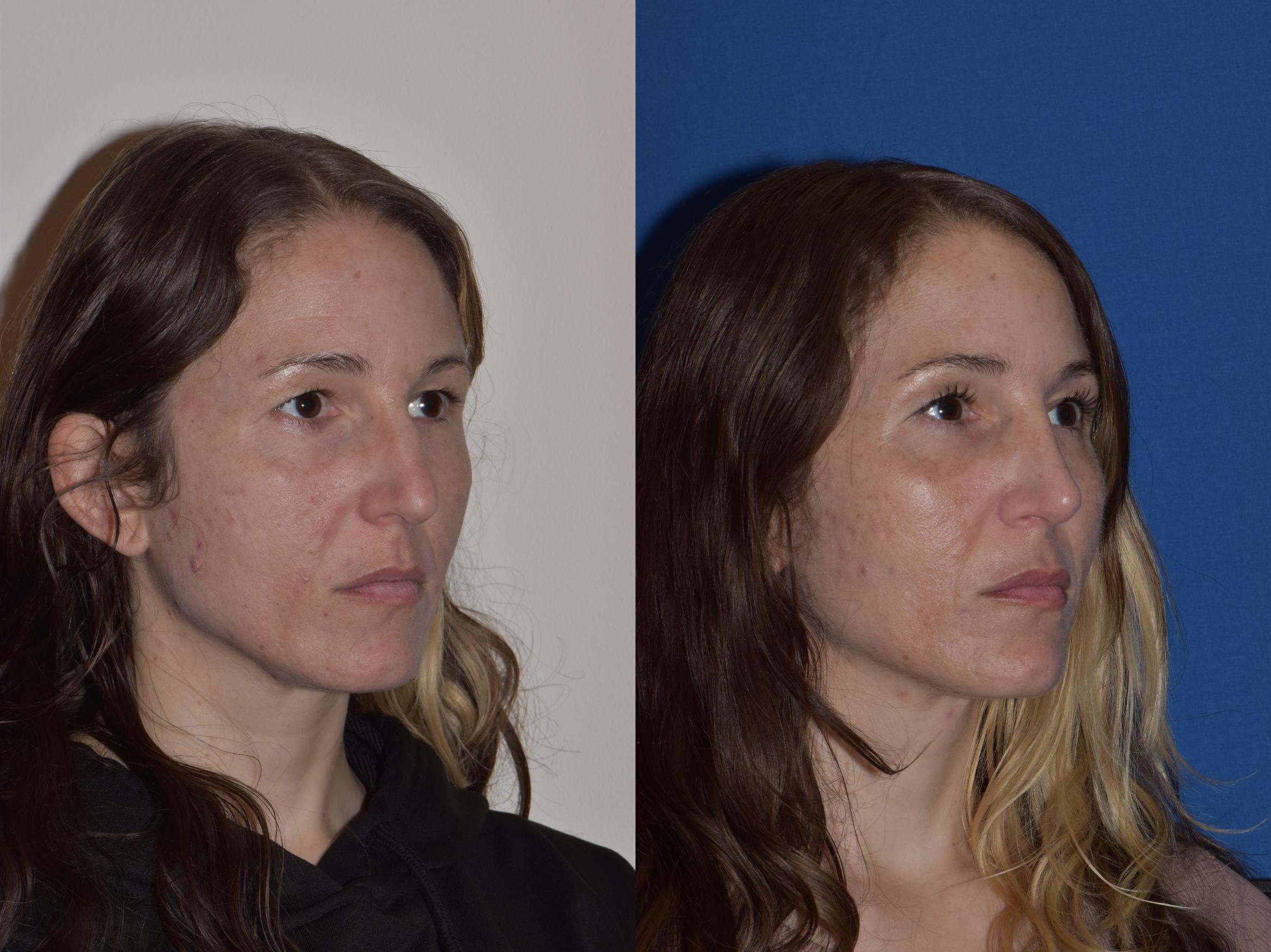 Before & After Rhinoplasty Case 2 Right Oblique View in South Miami, Florida