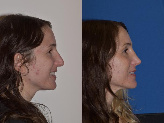 Before & After Rhinoplasty Case 2 Right Side Smiling View in South Miami, Florida