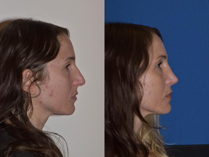 Before & After Rhinoplasty Case 2 Right Side View in South Miami, Florida