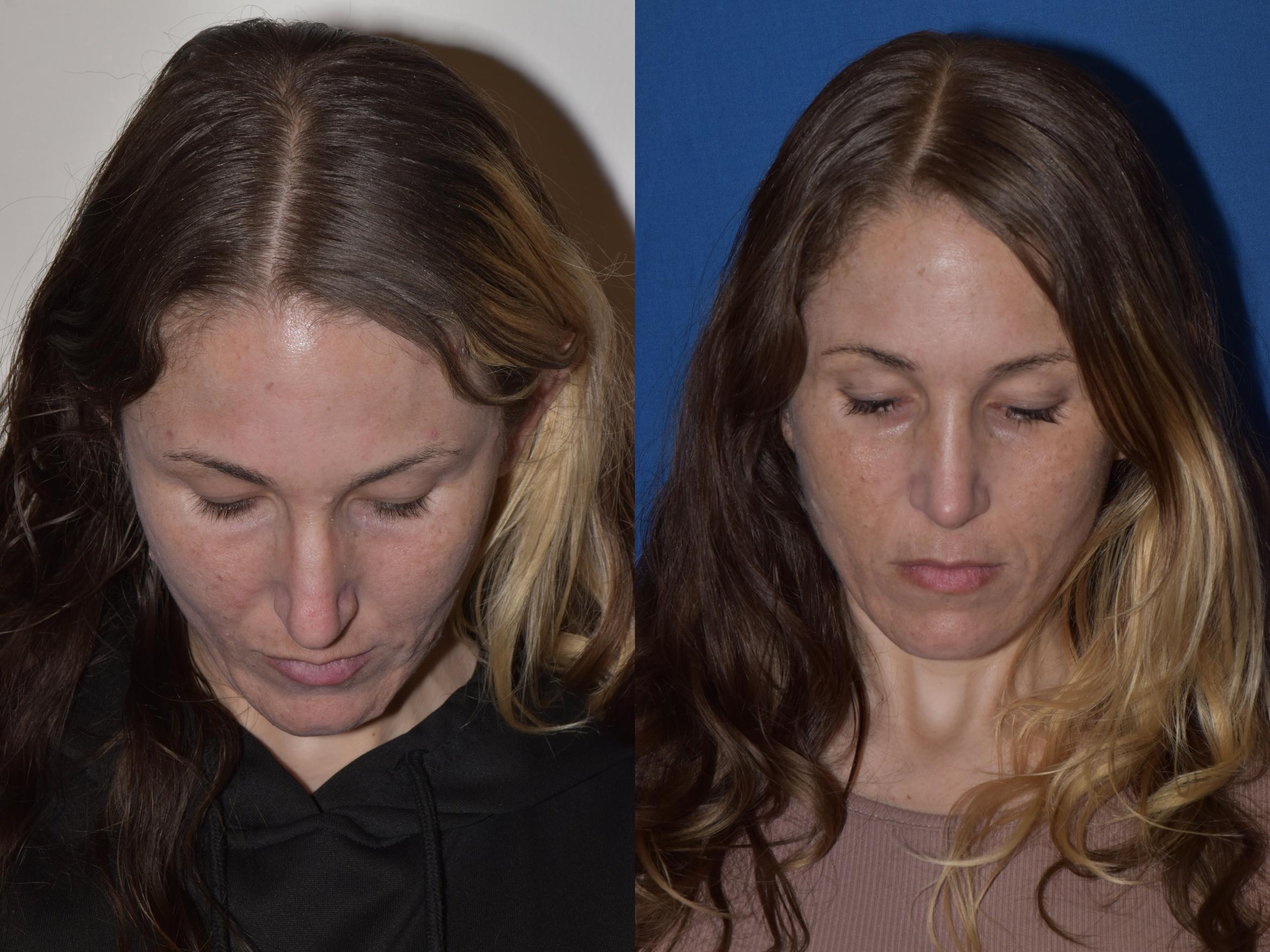 Before & After Rhinoplasty Case 2 Top View in South Miami, Florida