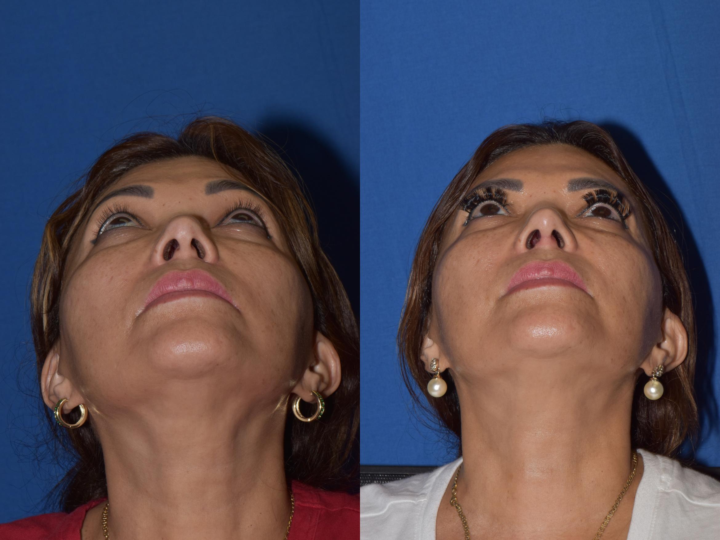 Before & After Rhinoplasty Case 3 Bottom View in South Miami, Florida