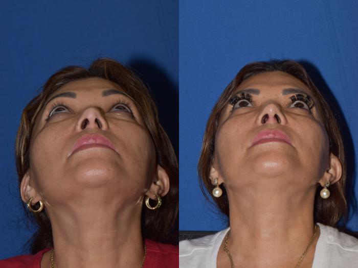 Before & After Rhinoplasty Case 3 Bottom View in South Miami, Florida