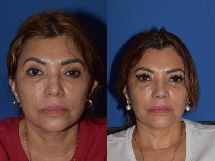 Before & After Rhinoplasty Case 3 Front View in South Miami, Florida