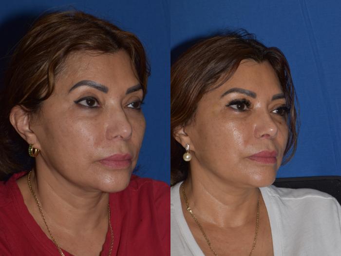 Before & After Rhinoplasty Case 3 Left Oblique View in South Miami, Florida