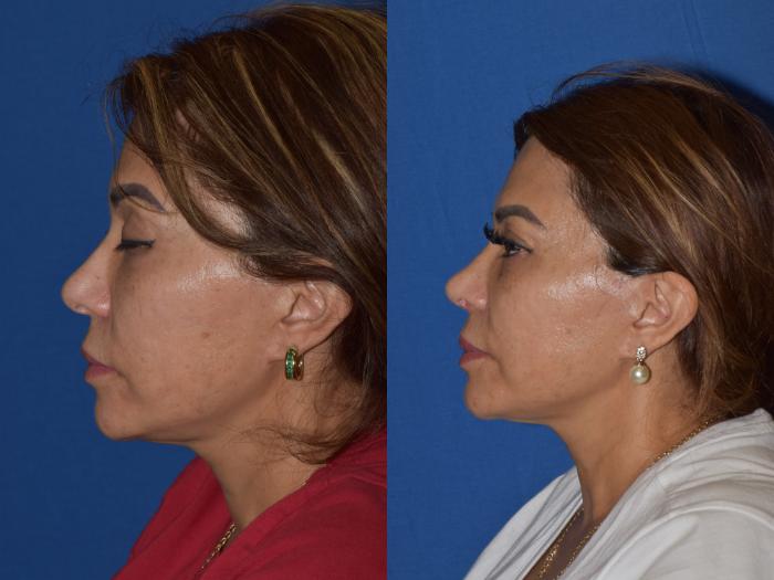 Before & After Rhinoplasty Case 3 Left Side View in South Miami, Florida