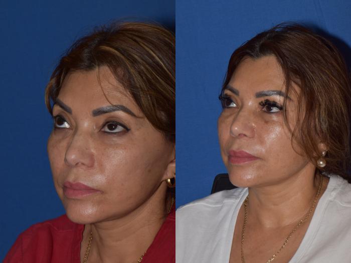 Before & After Rhinoplasty Case 3 Right Oblique View in South Miami, Florida