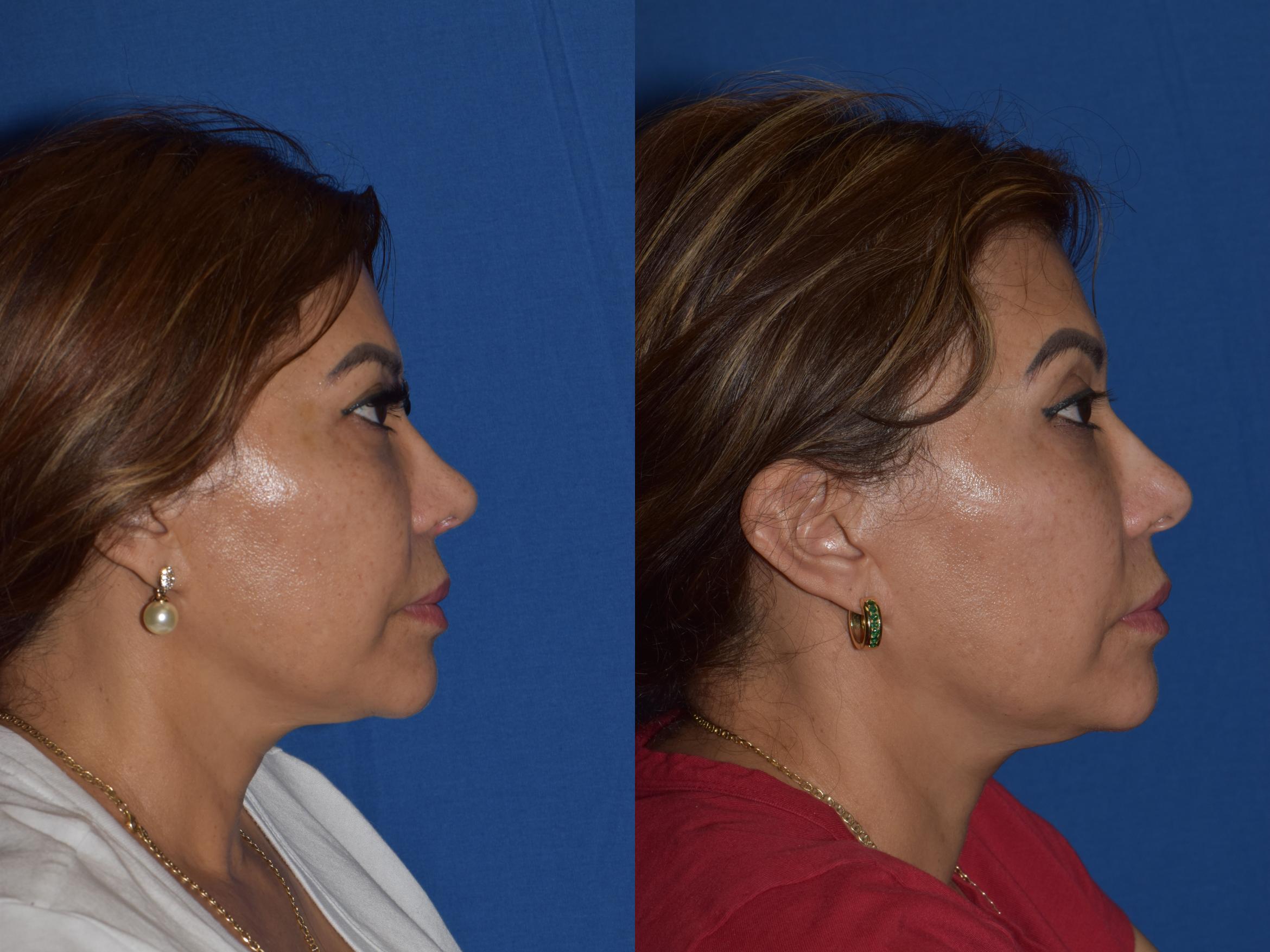 Before & After Rhinoplasty Case 3 Right Side View in South Miami, Florida