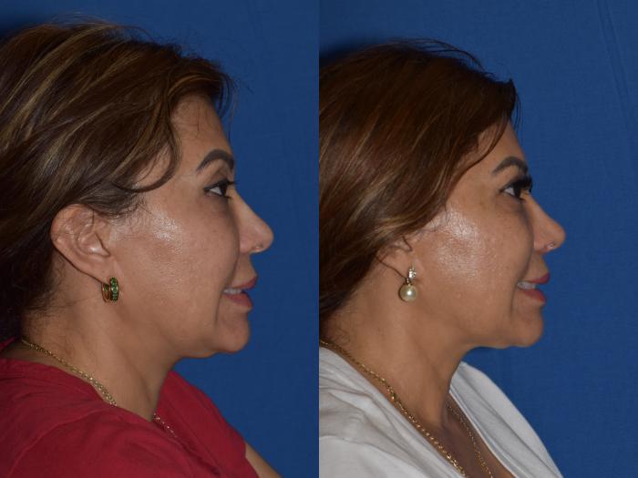 Before & After Rhinoplasty Case 3 Right Side Smiling View in South Miami, Florida