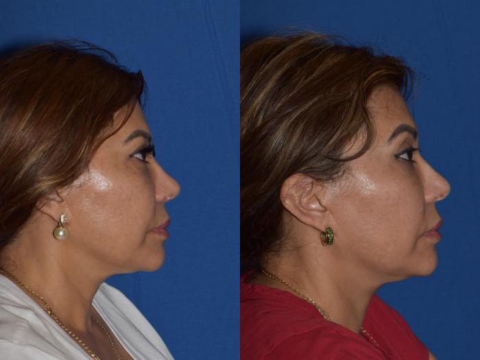 Before & After Rhinoplasty Case 3 Right Side View in South Miami, Florida