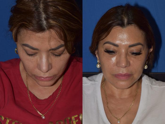 Before & After Rhinoplasty Case 3 Top View in South Miami, Florida
