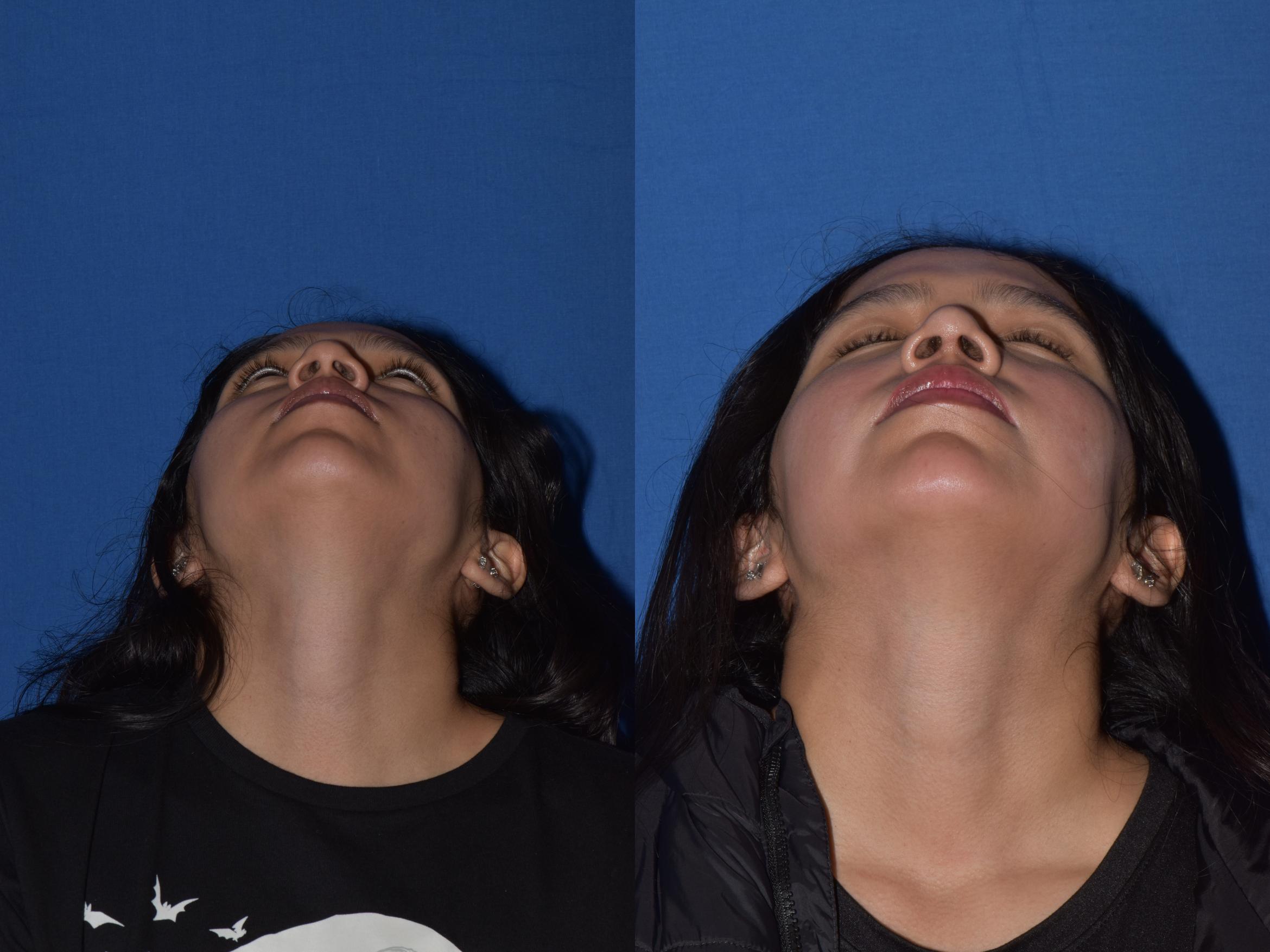 Before & After Rhinoplasty Case 4 Bottom View in South Miami, Florida