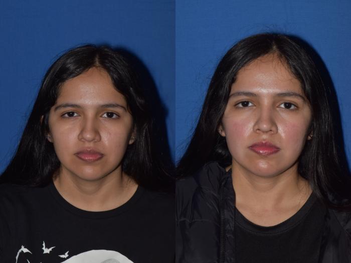 Before & After Rhinoplasty Case 4 Front View in South Miami, Florida