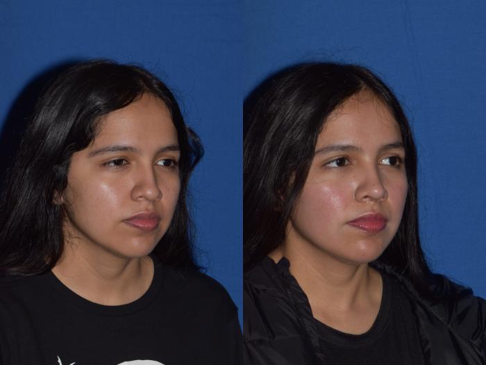 Before & After Rhinoplasty Case 4 Left Oblique View in South Miami, Florida