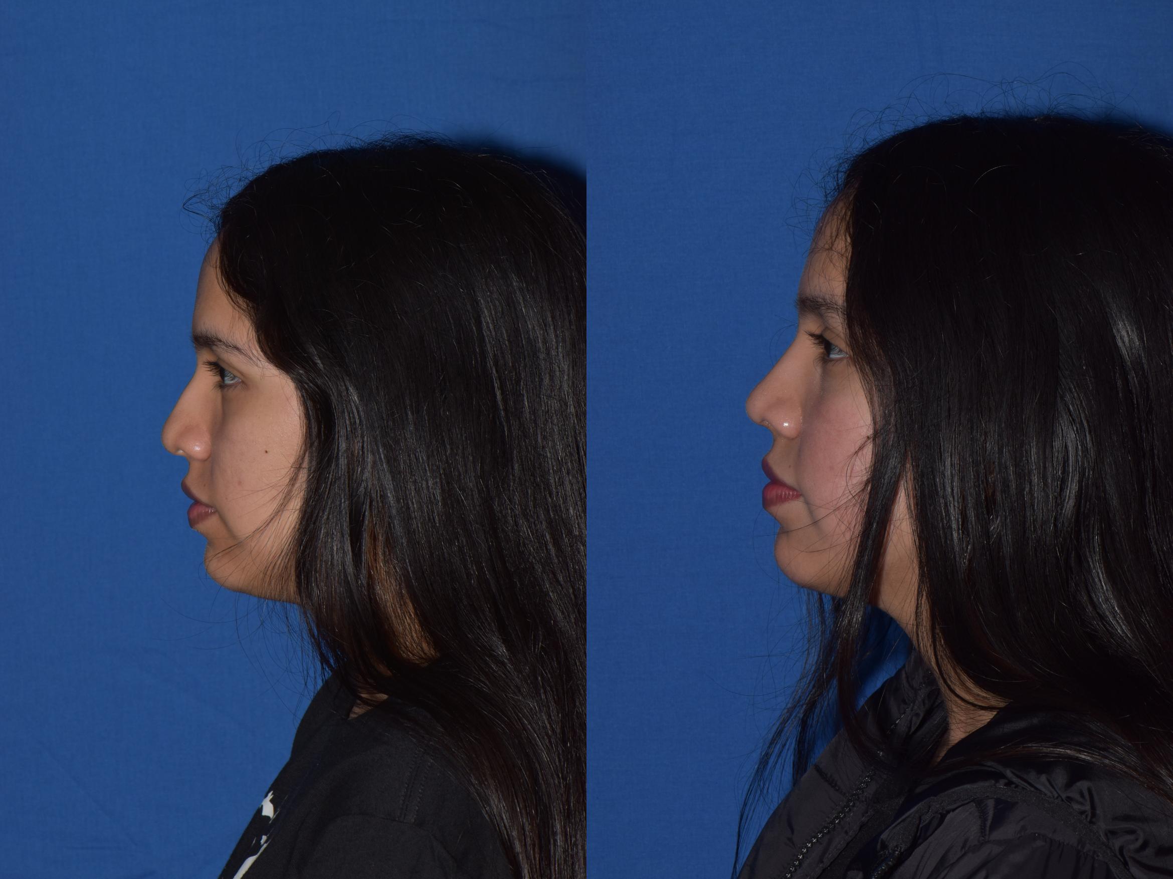 Before & After Rhinoplasty Case 4 Left Side View in South Miami, Florida