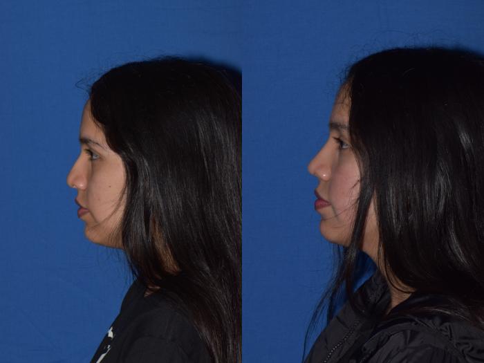 Before & After Rhinoplasty Case 4 Left Side View in South Miami, Florida