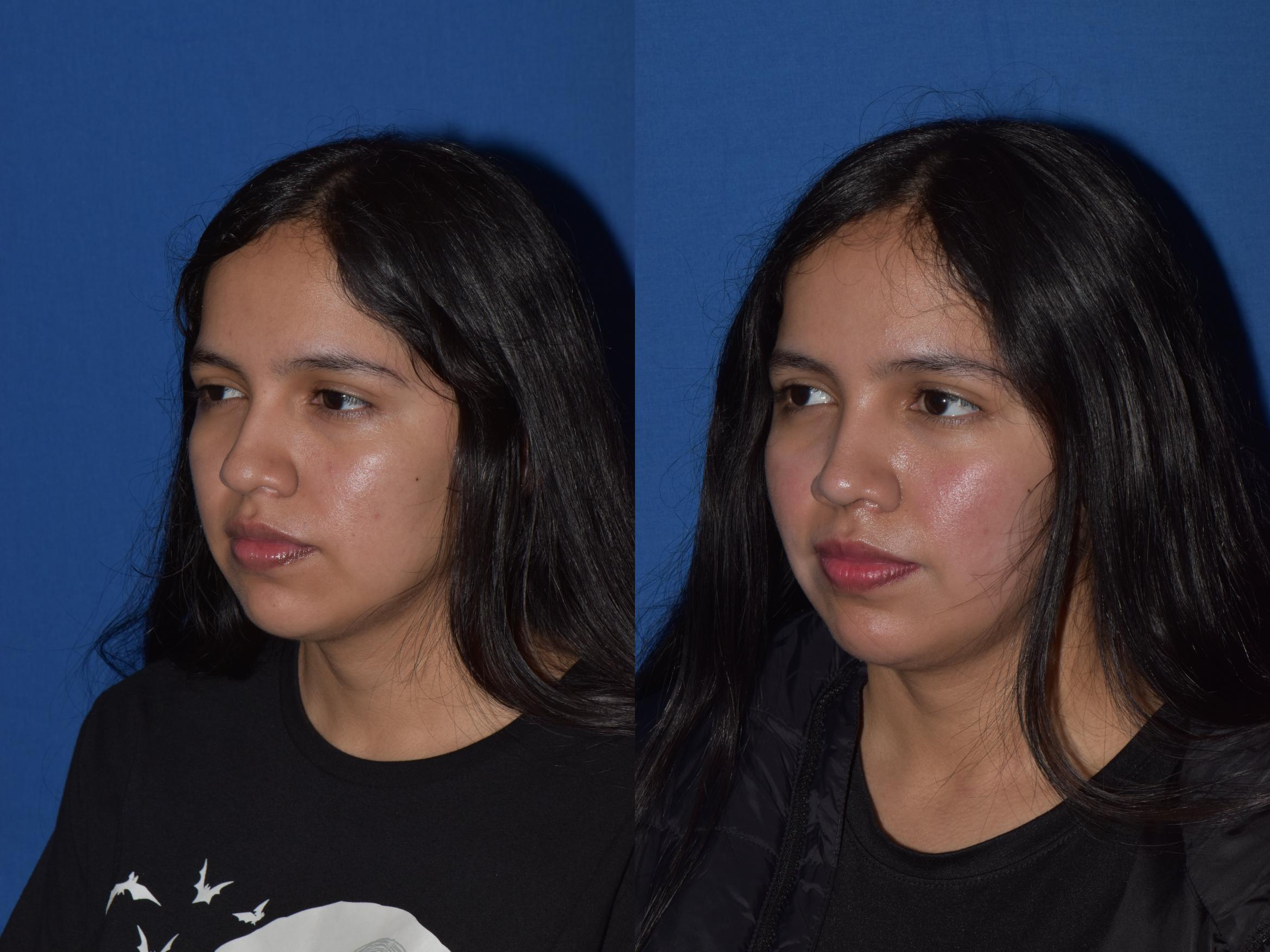 Before & After Rhinoplasty Case 4 Right Oblique View in South Miami, Florida