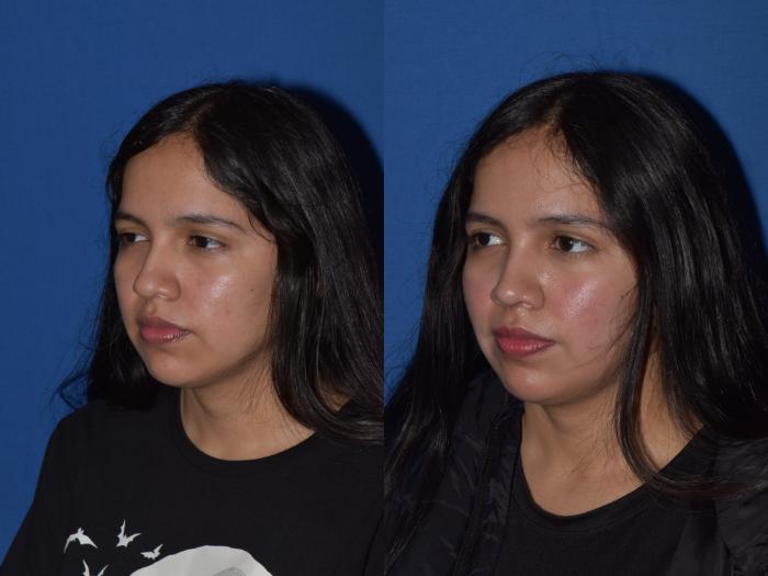 Before & After Rhinoplasty Case 4 Right Oblique View in South Miami, Florida