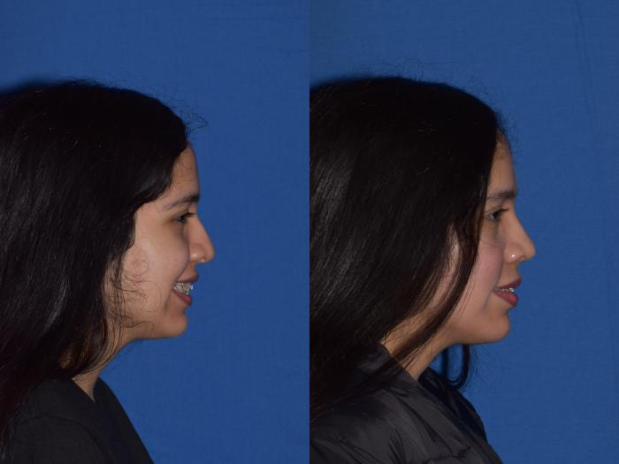 Before & After Rhinoplasty Case 4 Right Side Smiling View in South Miami, Florida