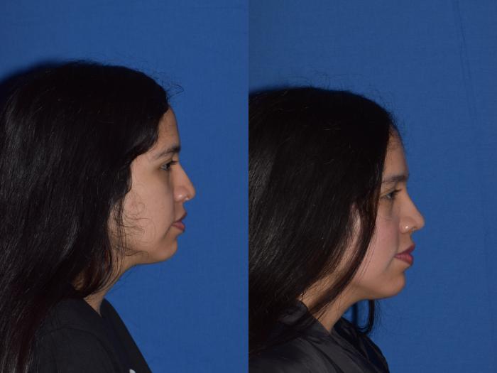 Before & After Rhinoplasty Case 4 Right Side View in South Miami, Florida