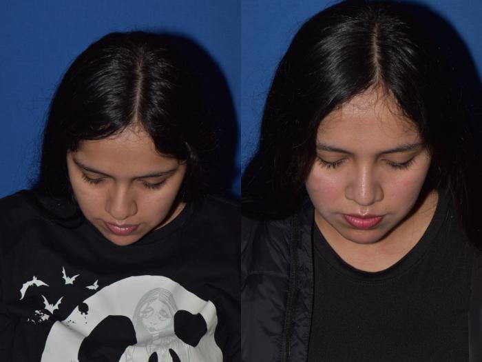 Before & After Rhinoplasty Case 4 Top View in South Miami, Florida