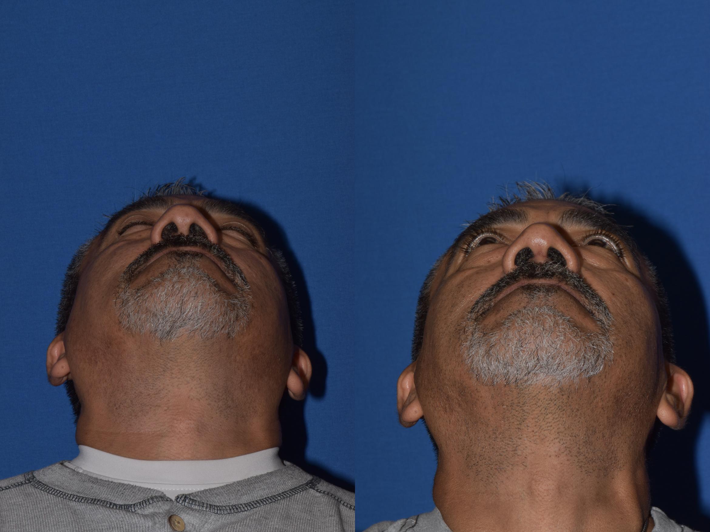 Before & After Rhinoplasty Case 7 Bottom View in South Miami, Florida
