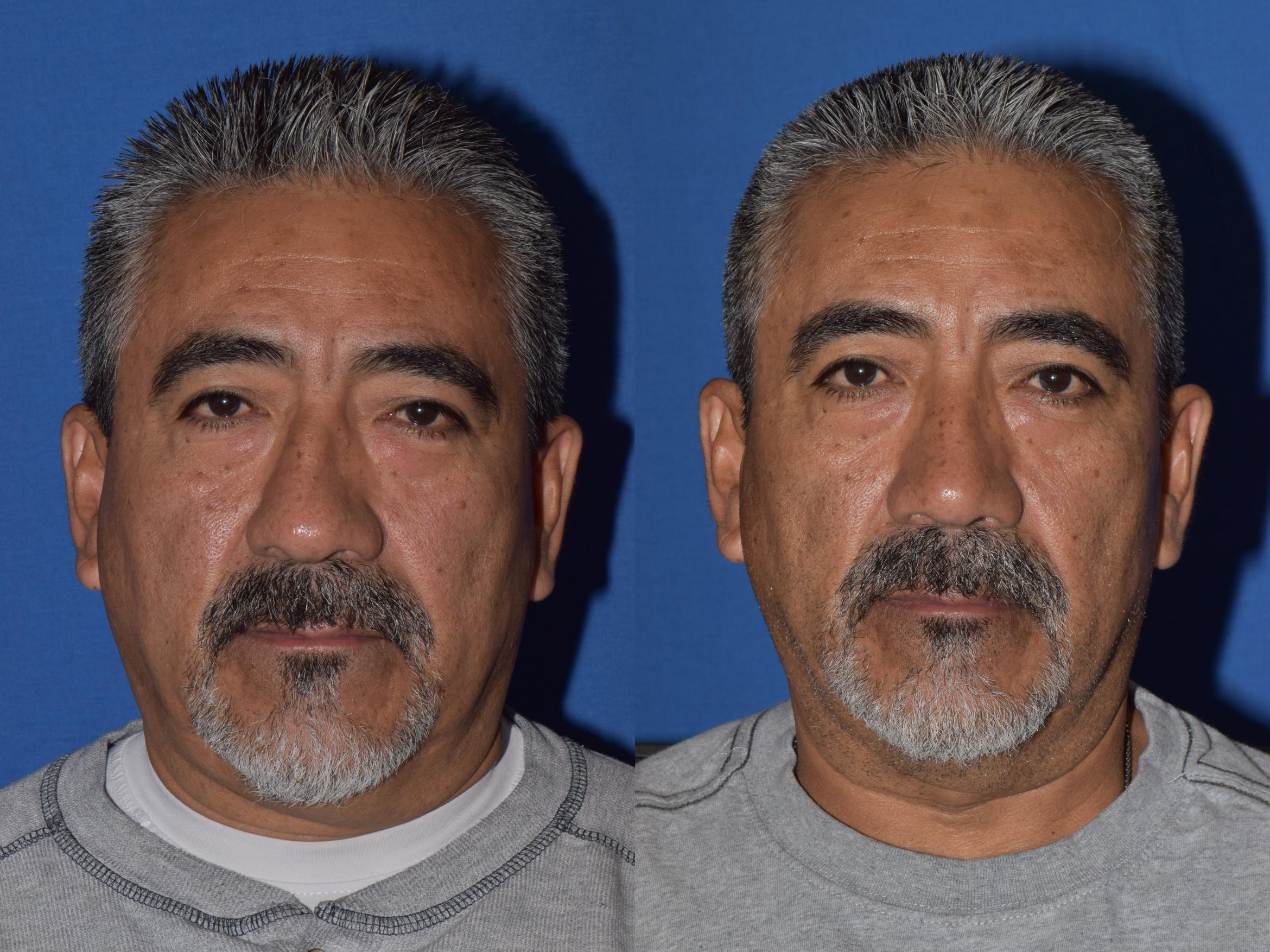 Before & After Rhinoplasty Case 7 Front View in South Miami, Florida