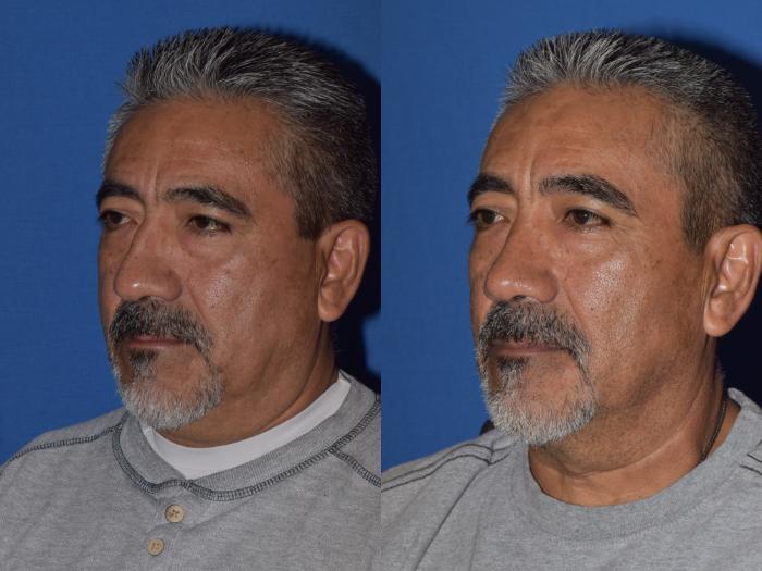 Before & After Rhinoplasty Case 7 Left Oblique View in South Miami, Florida
